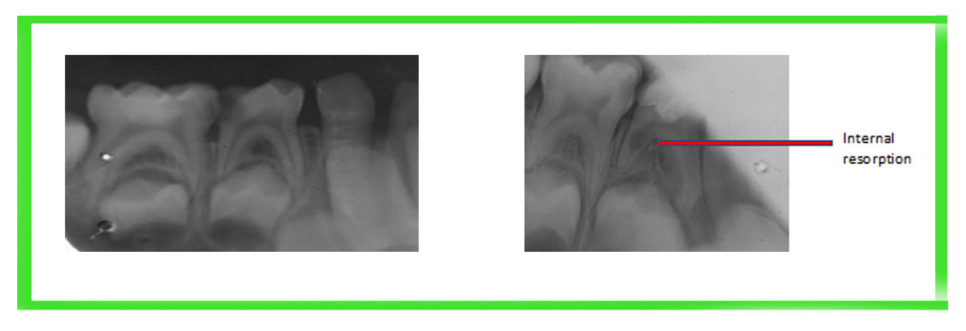 Clinical And Radiographic Efficacy Of Portland Cement As Pulpotomy